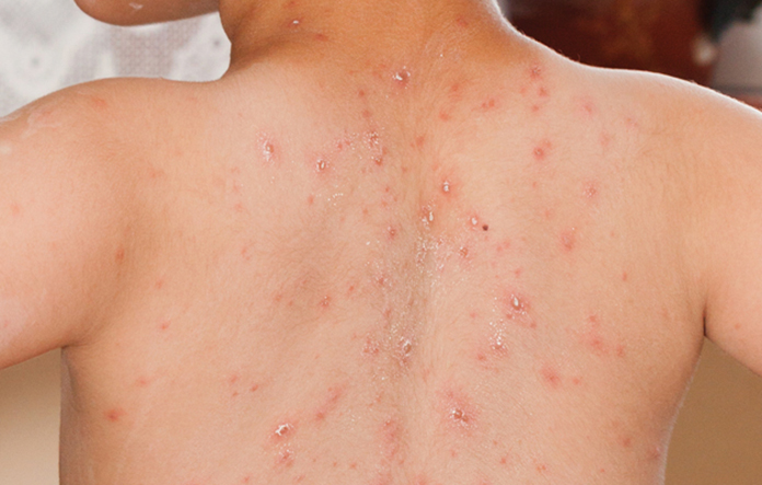 Demi Lindungi Named & Nakes Atas Penularan Campak, Kemenkes RI Resmi Keluarkan Surat Edaran