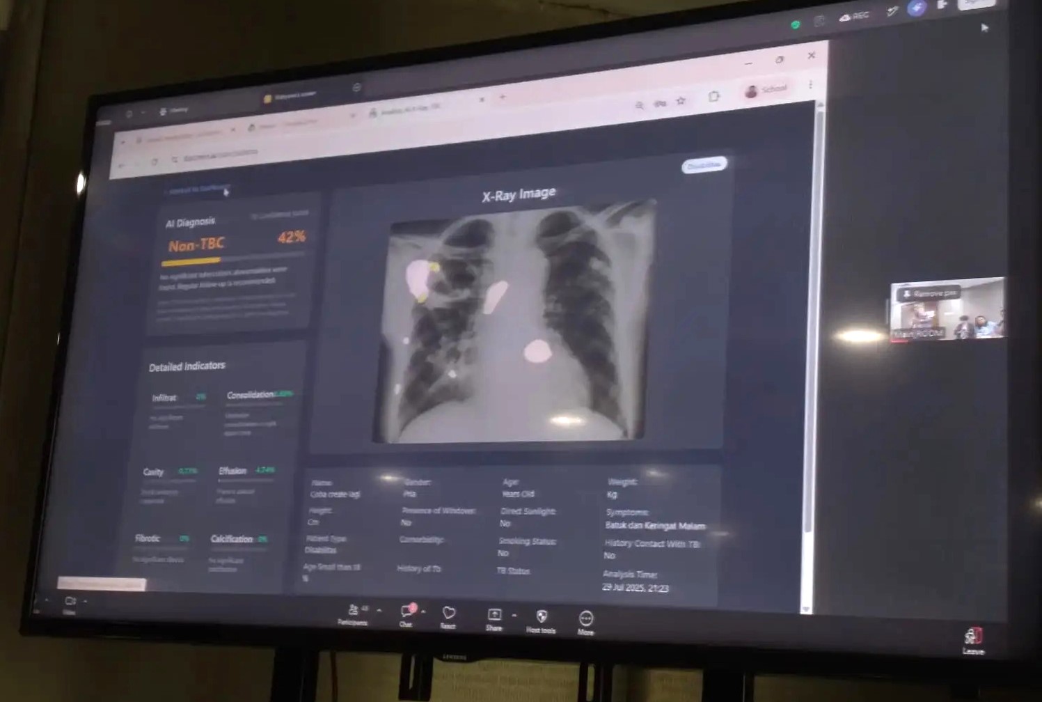 Kemenkes Kembangkan Inovasi Teknologi AI: Upaya Percepat Eliminasi Tuberkulosis